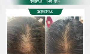 合肥安之酸养发馆生发效果怎么样