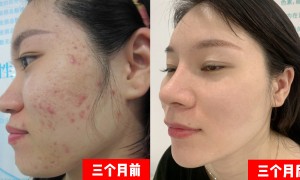 亦庄经济技术开发区痤疮治疗推荐适合敏感肌的皮肤管理机构，春树下口碑好